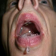 Hypersalivation